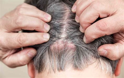 It's characterized by skin cells that multiply up to 10 times faster than normal. . Pictures of scabs on scalp